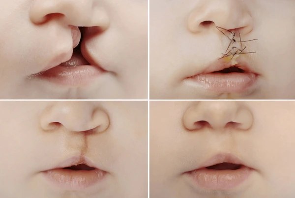 Cleft Lip & Palate Surgery