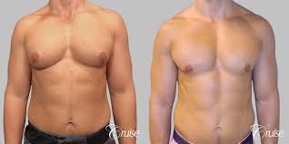 Gynecomastia Surgery