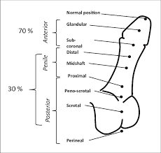 Hypospadias Surgery