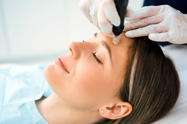 Microneedling/Acne Scars Treatment