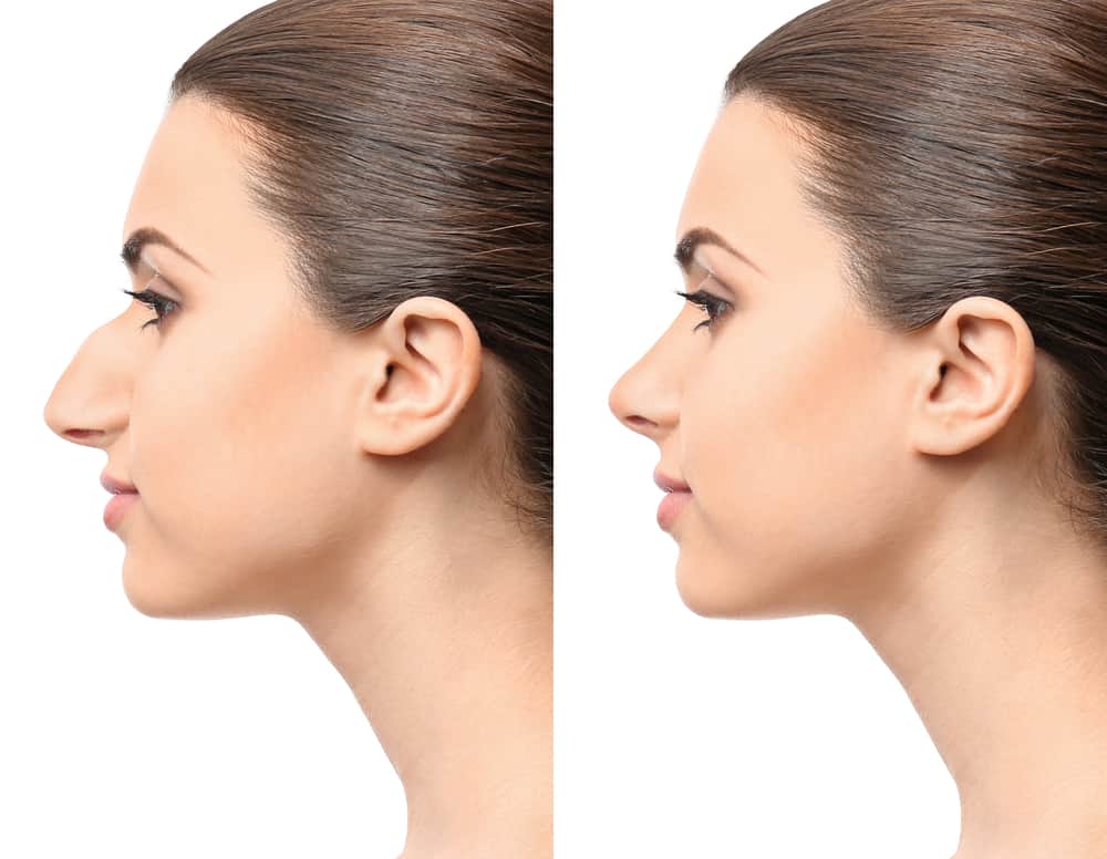 Surgical / Non-Surgical Rhinoplasty